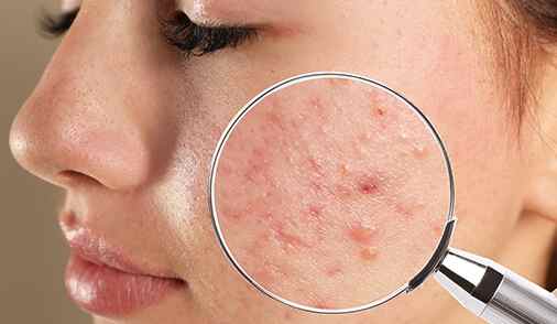 Acne-Pimples