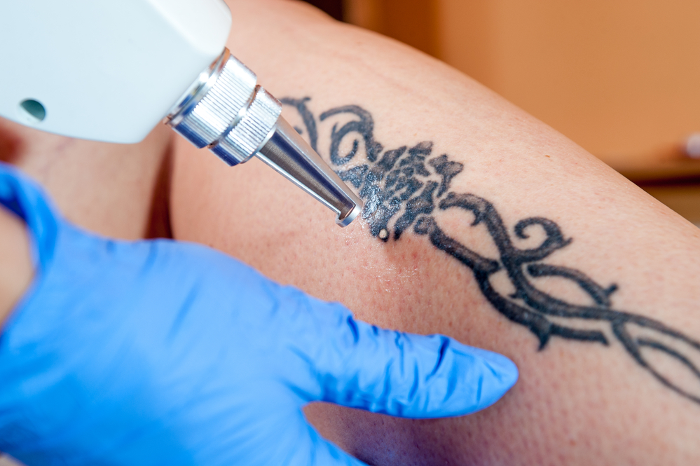 tattoo removal