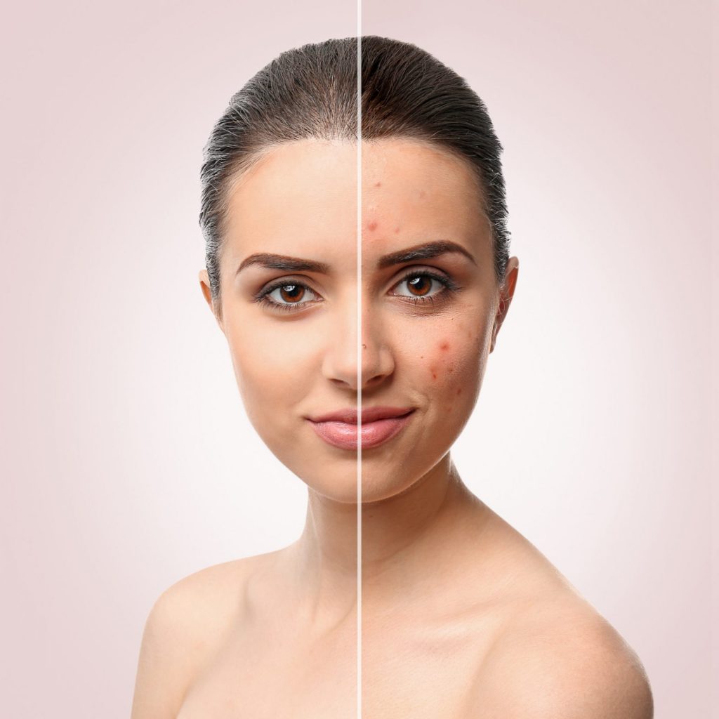 laser toning