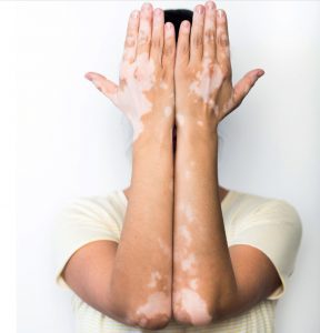 vitiligo