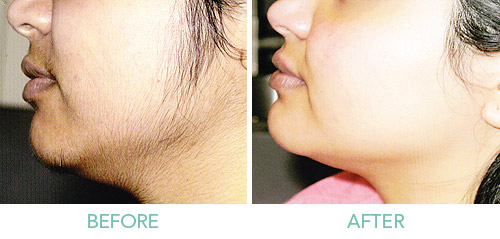hair-removal