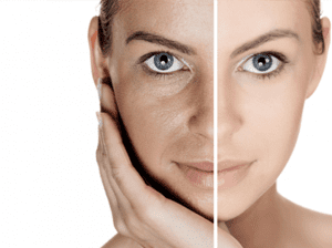 melasma-pigmentation