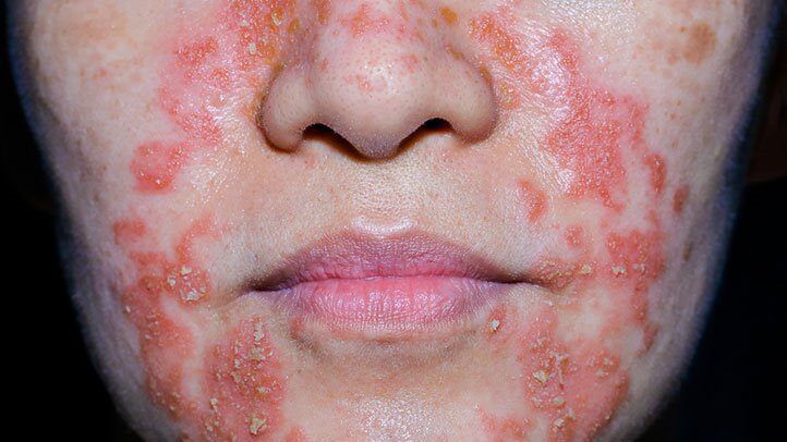 eczema