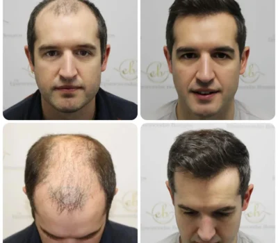 dr-bonaros-12-months-result-hair-transplant-scotland-_7_-768x768